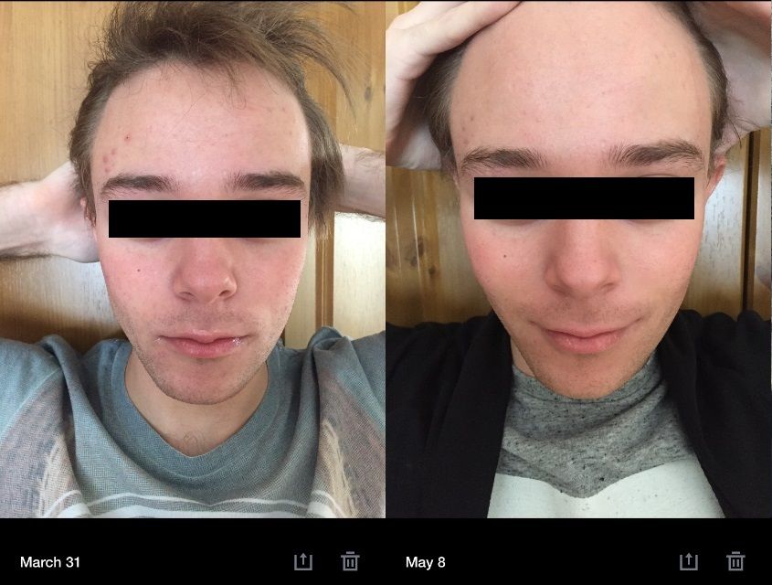 Accutane%20March-May%20Front_zpsr3h8ep66