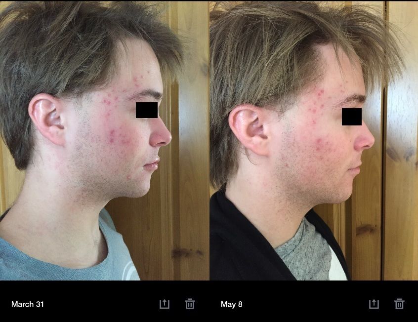 Accutane%20March-May%20Right_zps3kvyy90q